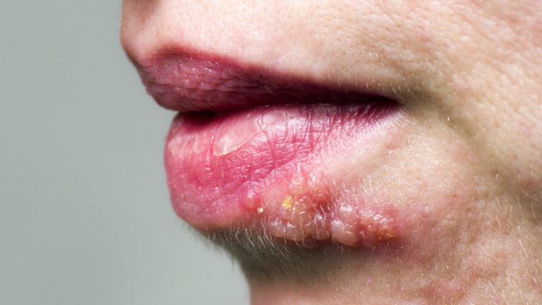 Researchers Discover Molecular Switch Blocking Herpes Virus Entry